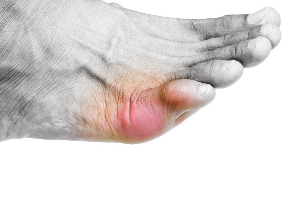 Up-to-date management of gout