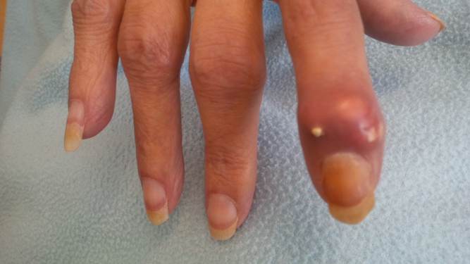 Chronic tophaceous gout