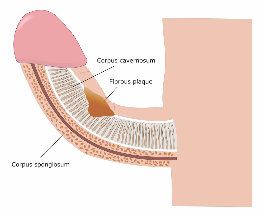 curved penis peyronies disease