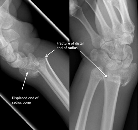 Distal end of radius fractures