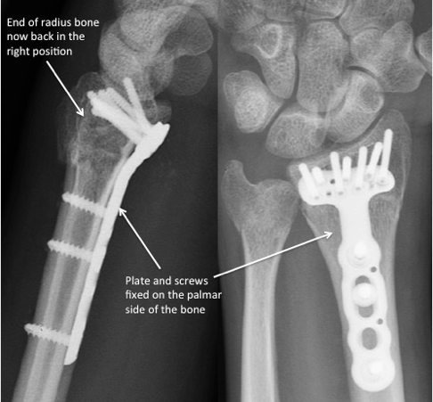 Plate and screws fixed to the palmar aspect of the bone