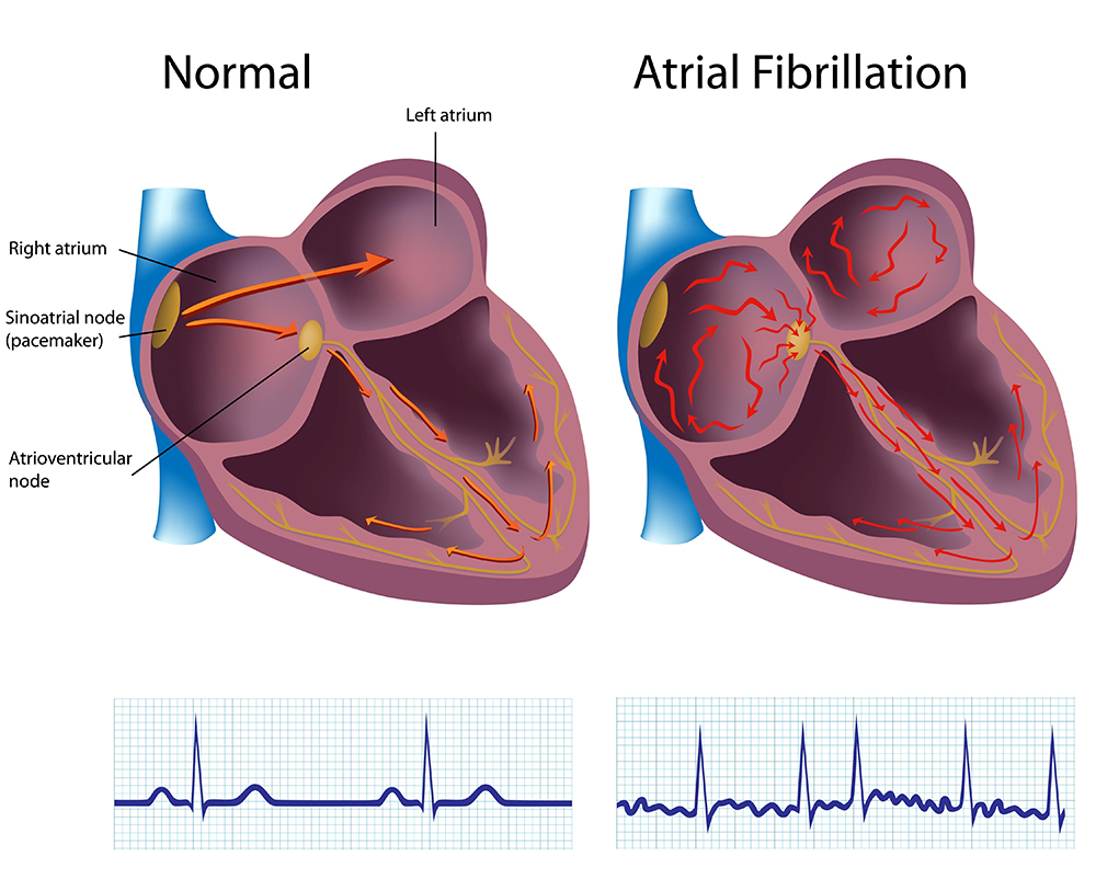 normal & atrial fibrillation