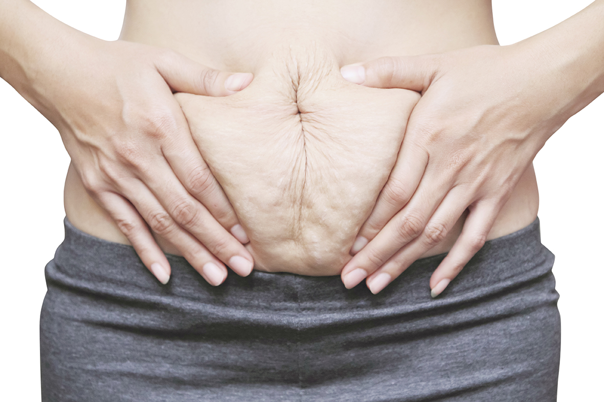 Abdominal separation during pregnancy