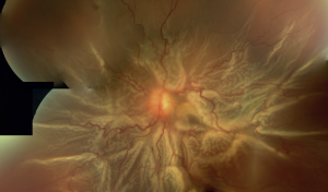 Advanced detachment of the retina