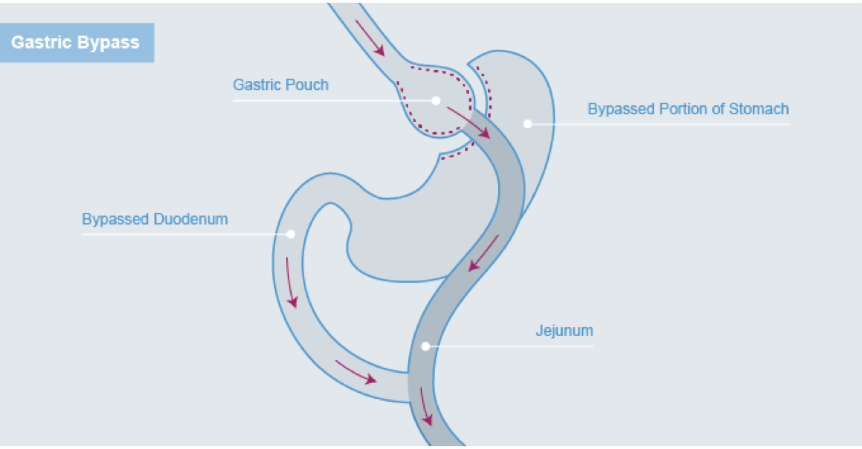 Gastric bypass