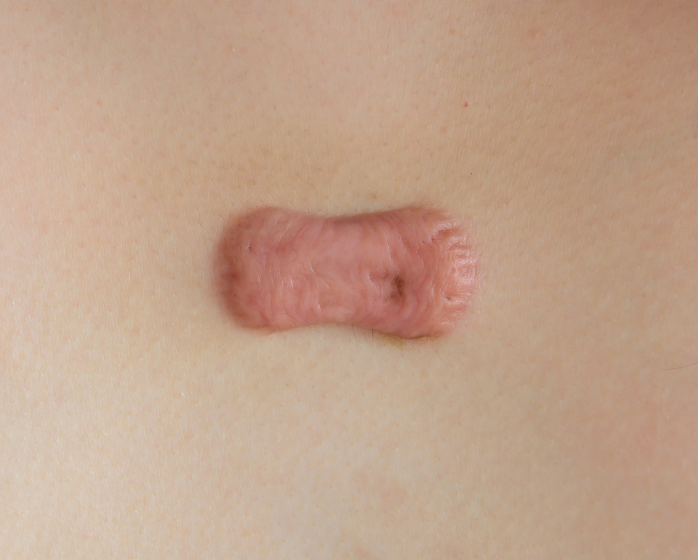 Keloid scars