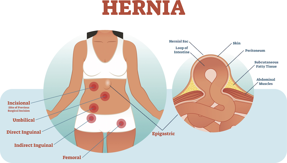 What is Hernia